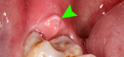 Признаки воспаления зуба мудрости